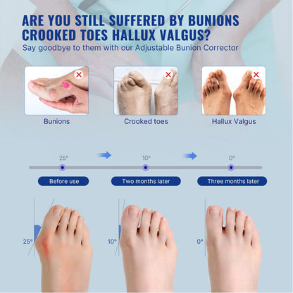 Healthadss ™ Adjustable Bunion Splint Brace Big Toe Straightener for Bunion Pain Relief, Hallux Valgus Correction Day/Night Support