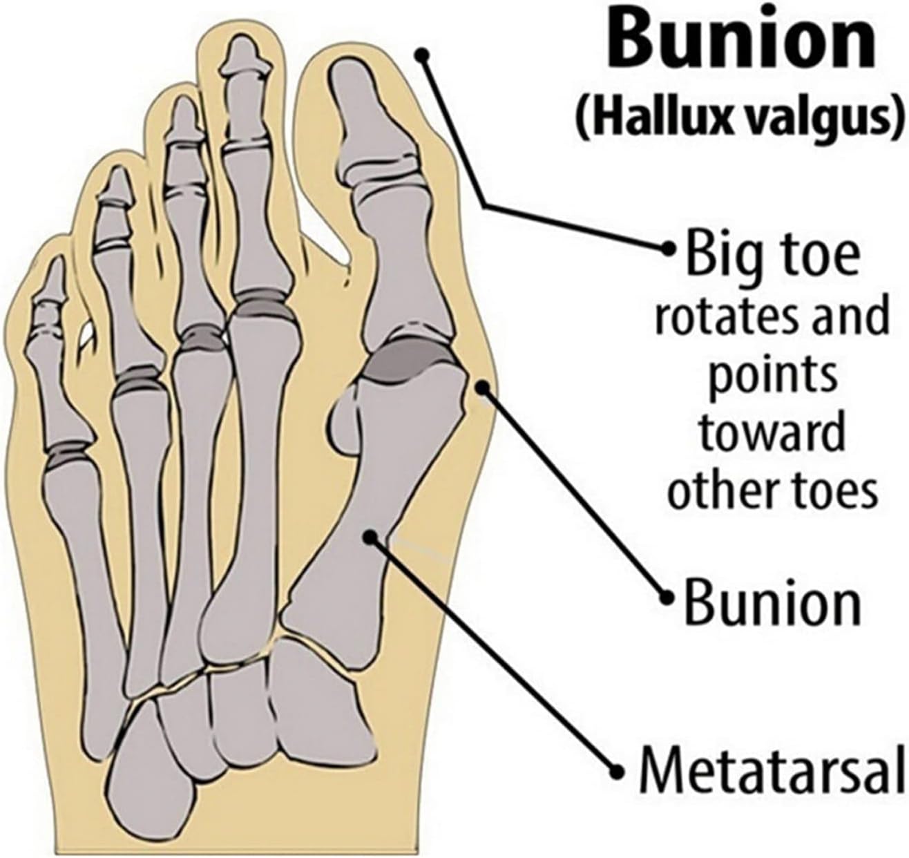 Healthadss ™ Bunion Corrector,Hallux Valgus Pain Relief,Comfortable & Breathable for Day/Night Support