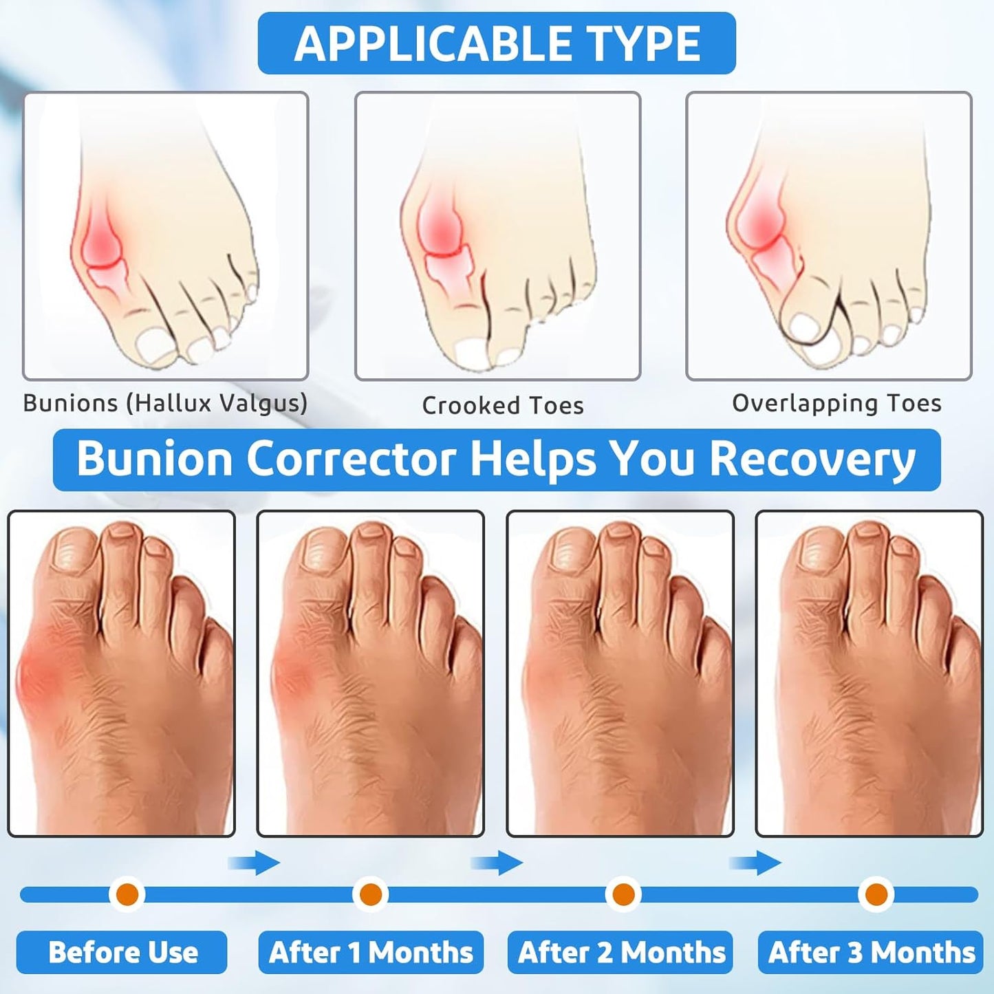 Healthadss ™ Orthopedic Bunion Corrector,Bunion Pads for Bunion Pain Relief