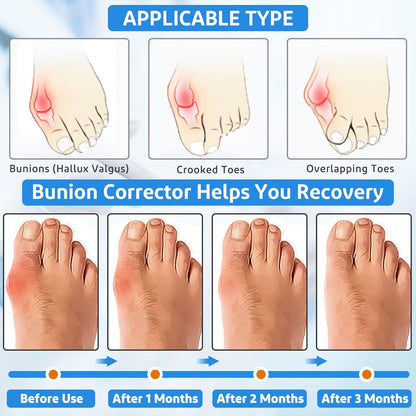 Healthadss ™ Orthopedic Bunion Corrector,Bunion Pads for Bunion Pain Relief