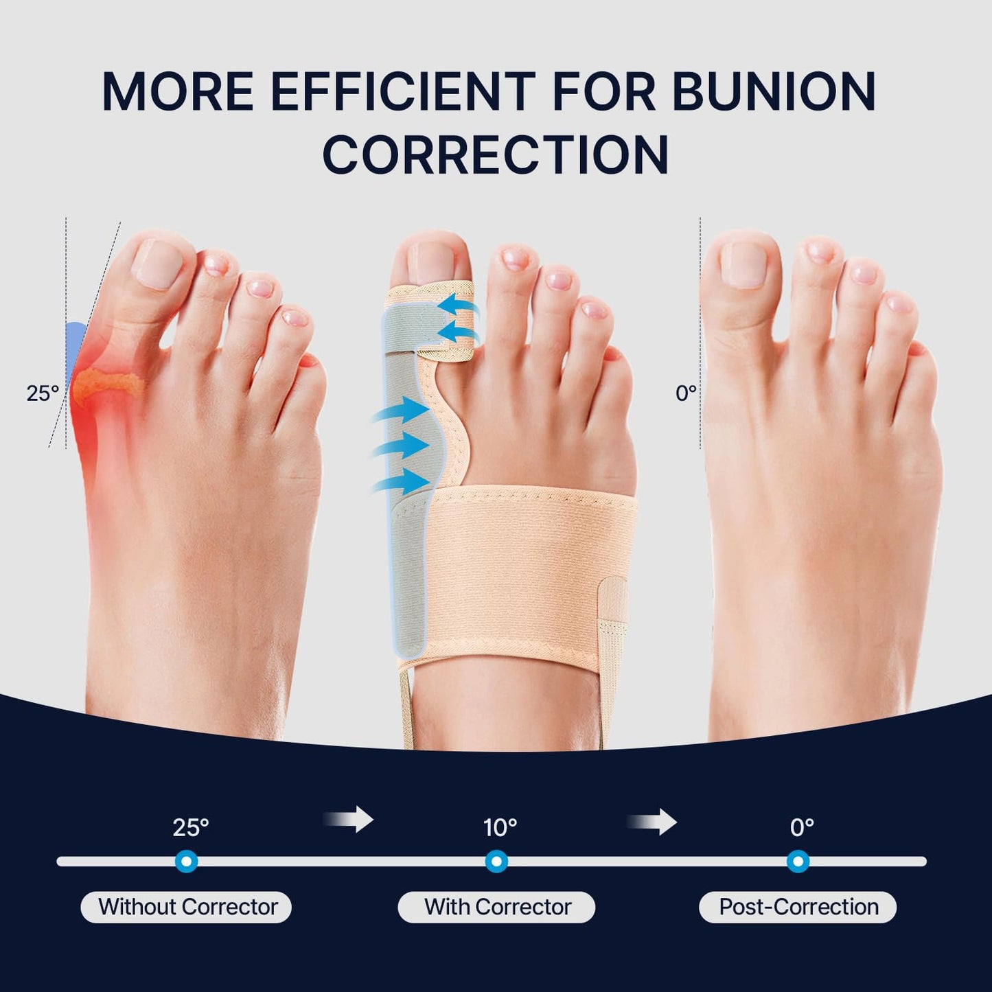 Healthadss ™ Adjustable Bunion Corrector,Upgraded Bunion Splint,Breathable Big Toe Straightener for Day/Night